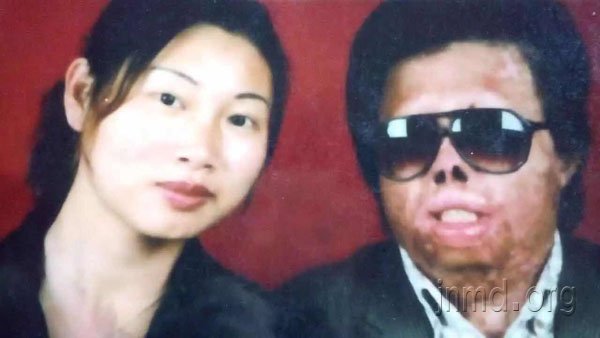 毁容残疾之后,神的爱点亮他的人生